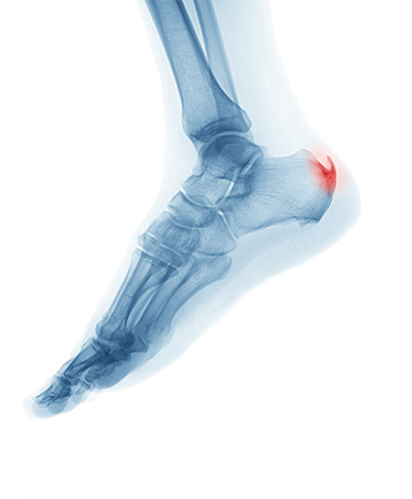 stock image showing xray of left foot with affected area in red color