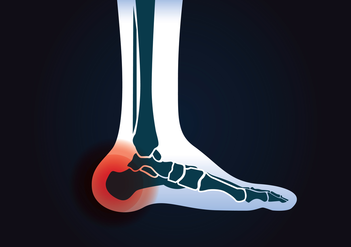concept of major factors for heel pain