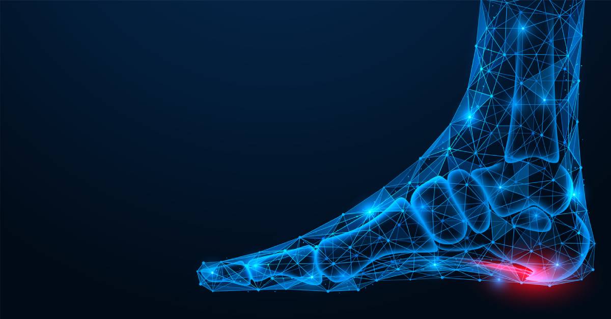 featured image of heel spurs a chronic condition