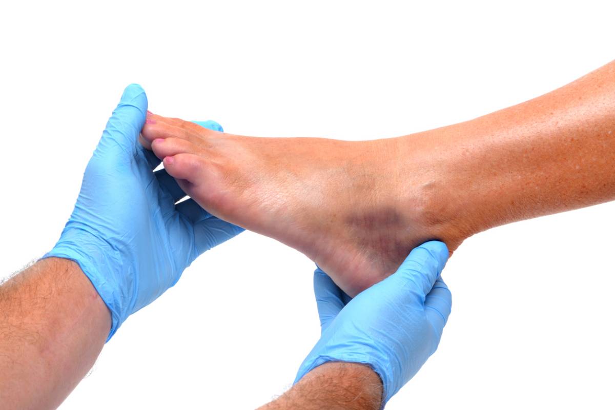 featured image for did i bruise or fracture my heel article