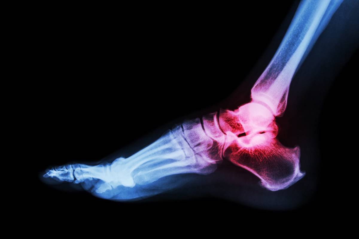 featured image for article about can foot pain mean arthritis